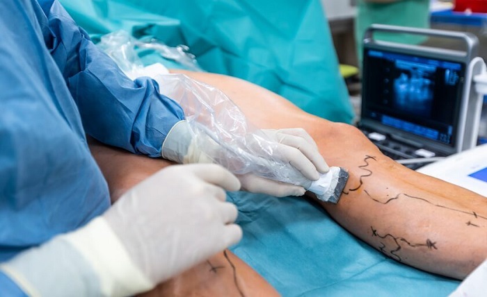 Varicose Veins Treatment Cost